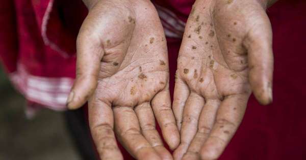 Nguy cơ tiềm ẩn khi sử dụng PAC Trung Quốc trong xử lý nước cấp