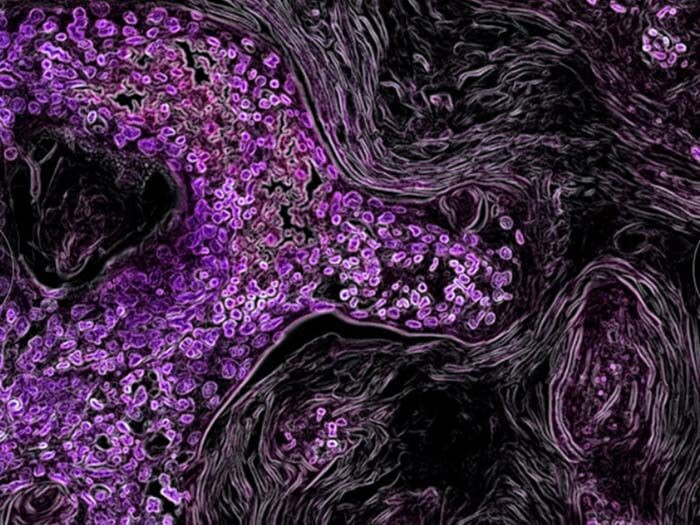Hình ảnh tế bào ung thư qua lăng kính hiển vi