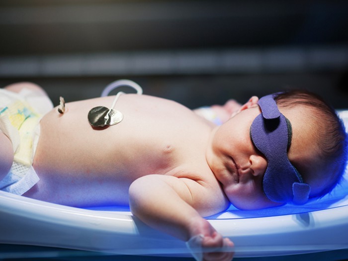 Ánh sáng xanh giúp chữa vàng da ở trẻ sơ sinh