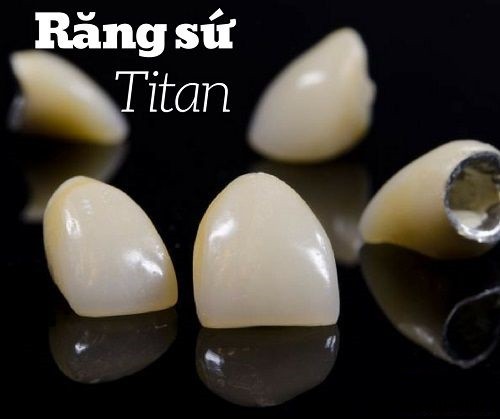 Chân răng nhân tạo bằng titan