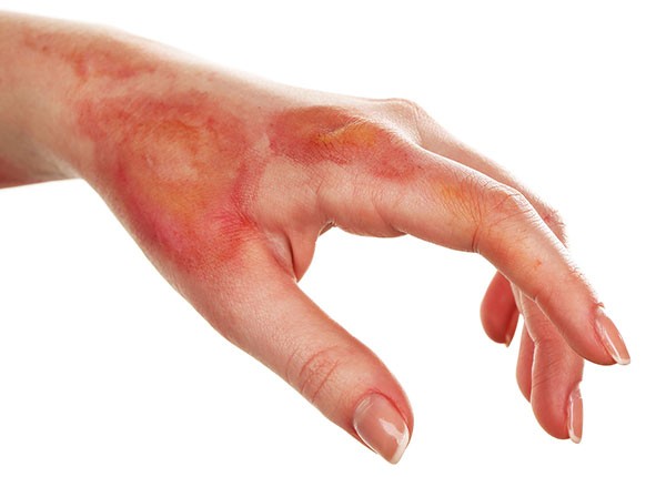 Phenol gây tình trạng bỏng nặng khi tiếp xúc với da