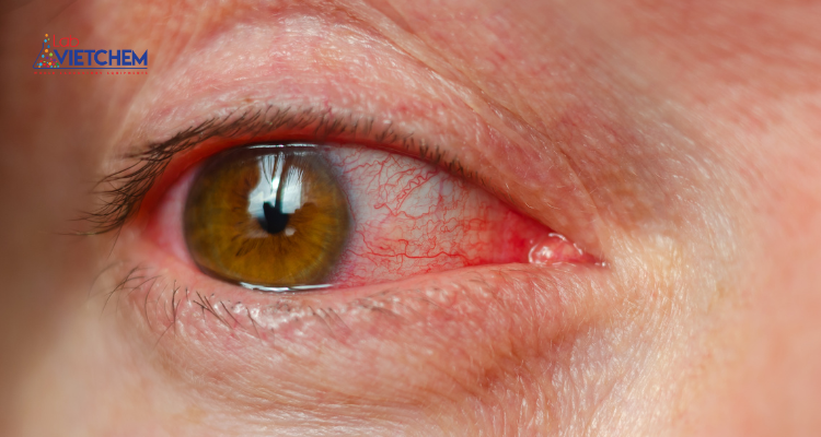 HBrO4 dính vào mắt gây đỏ, ngứa