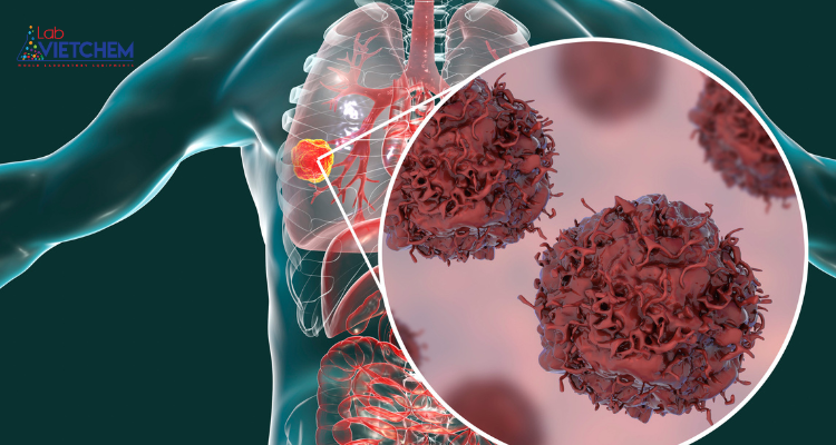 Kẽm cromat và mối liên quan với bệnh ung thư phổi